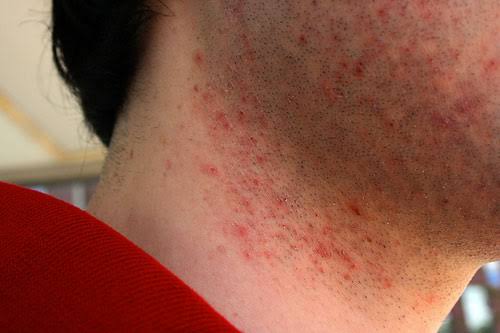 Razor Burn vs Razor Bumps vs Ingrown Hairs: How to Tell Which One You Have Image